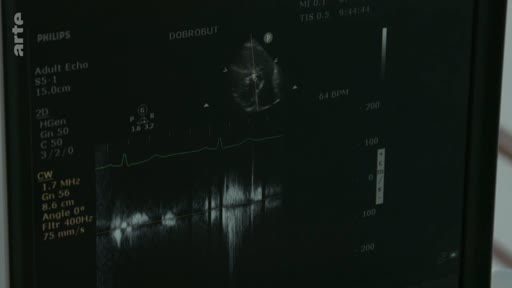 Un écran de moniteur médical Philips affichant une échographie cardiaque avec des données techniques et des tracés Doppler, utilisé lors d'un examen médical.